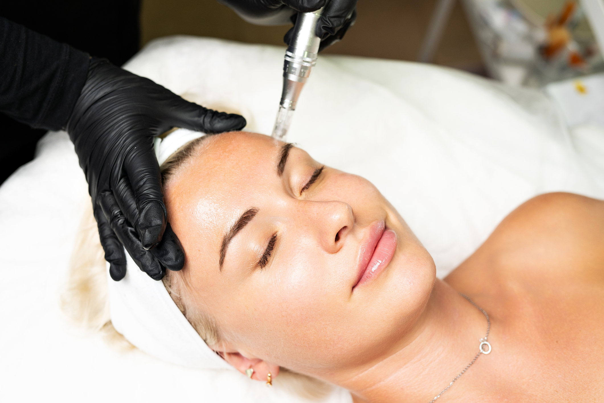 Microneedling