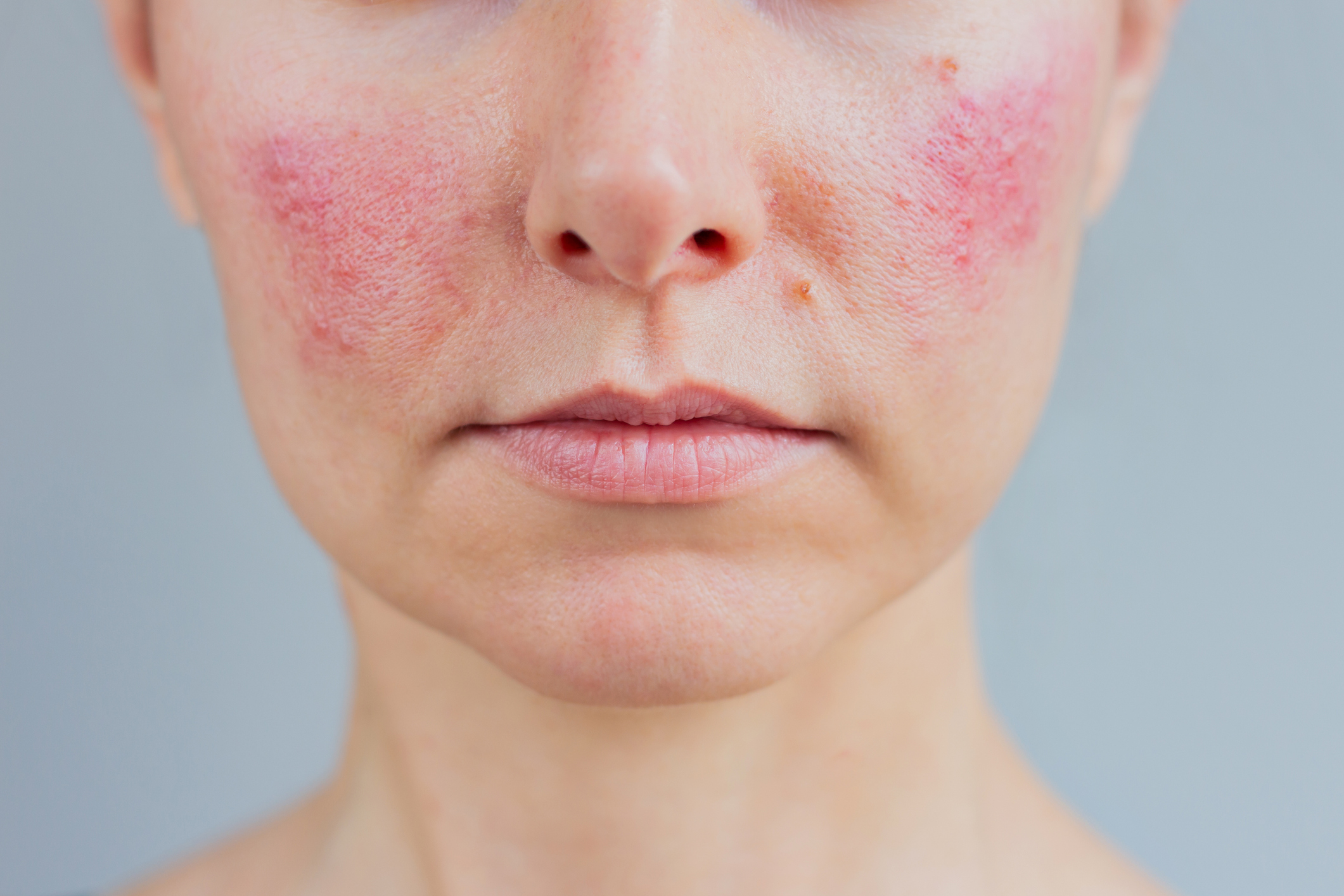 Rosacea Cheeks