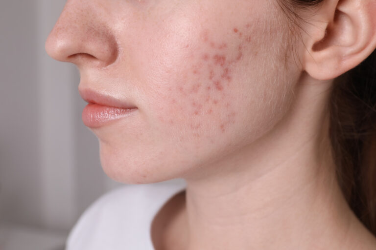 Acne Scarring Types & Treatments