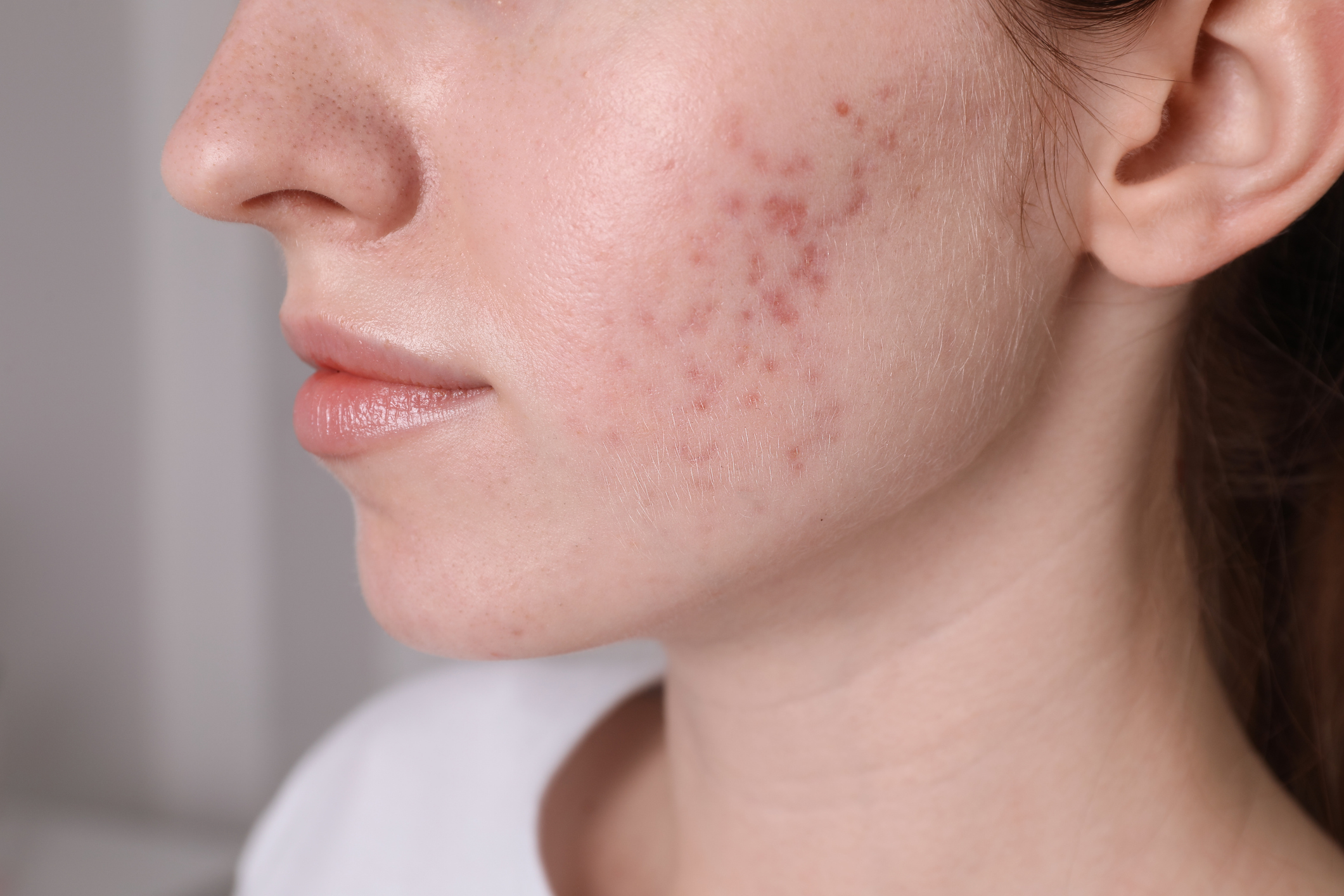 Acne Scarring Types & Treatments