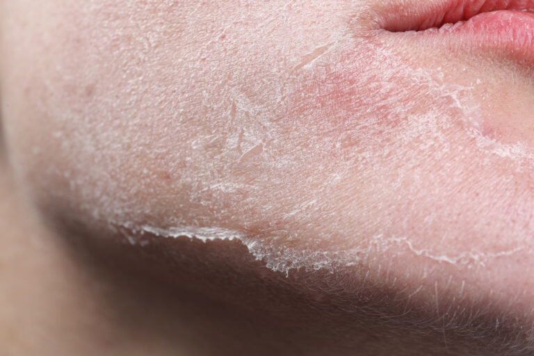 Dry Skin: Causes, Symptoms & Treatments