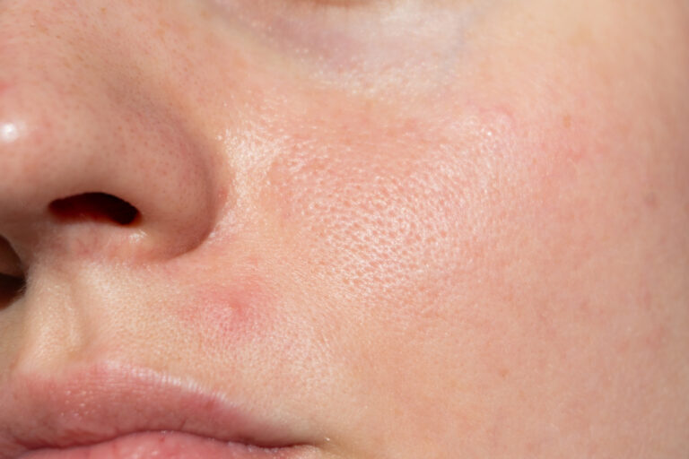 Oily Skin: Causes & Skincare Routine