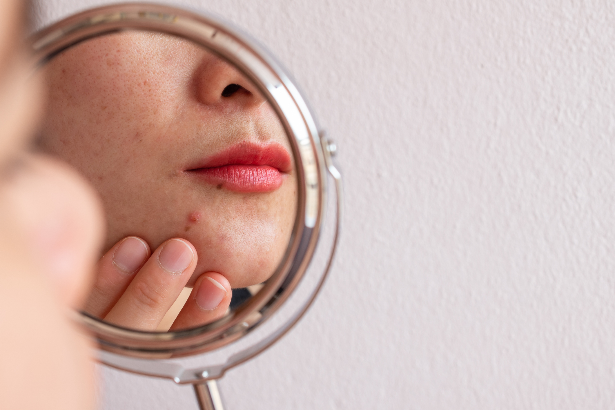 Barrier-Friendly Acne Treatments