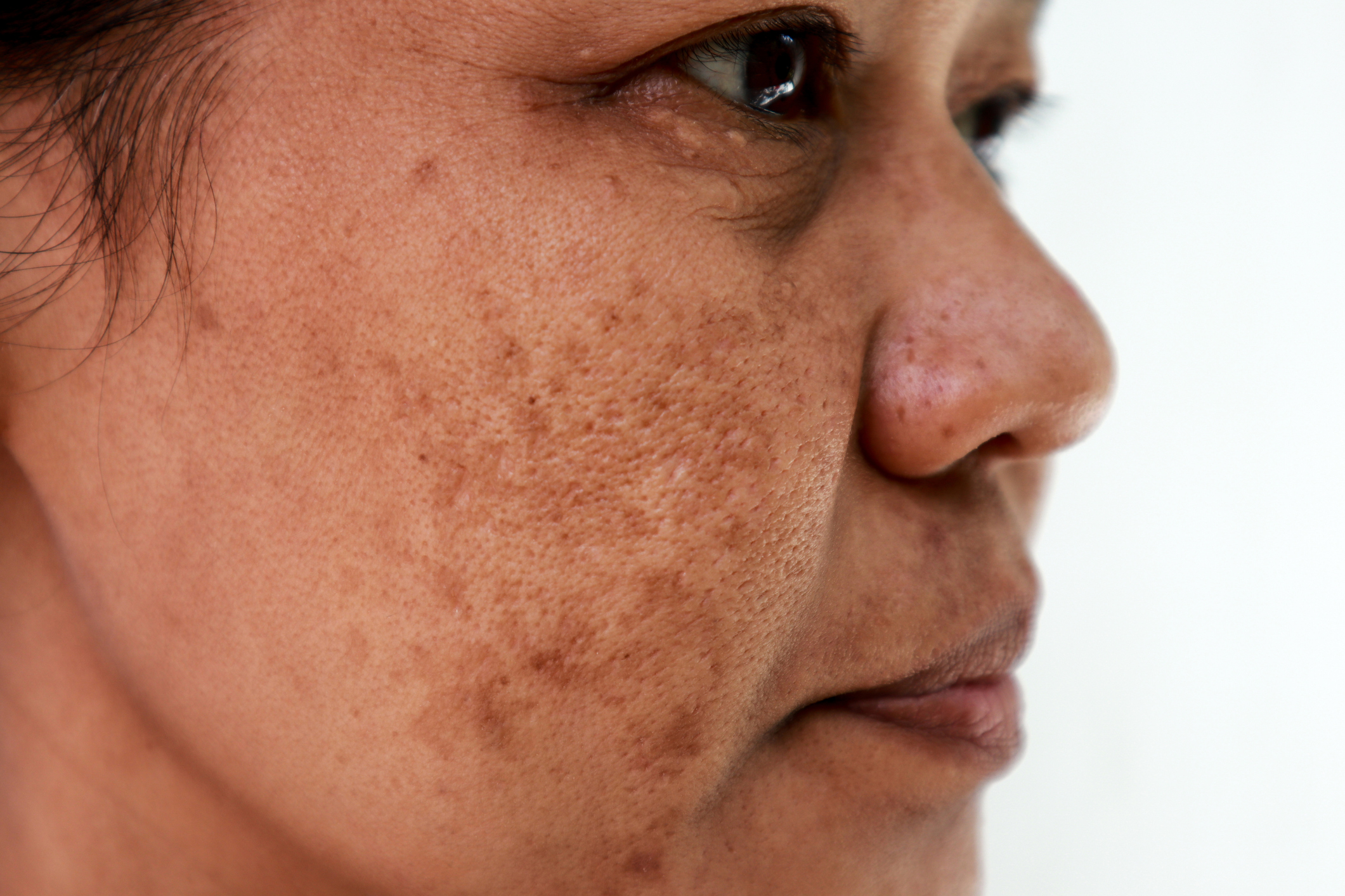 Melasma Skin Condition Overview