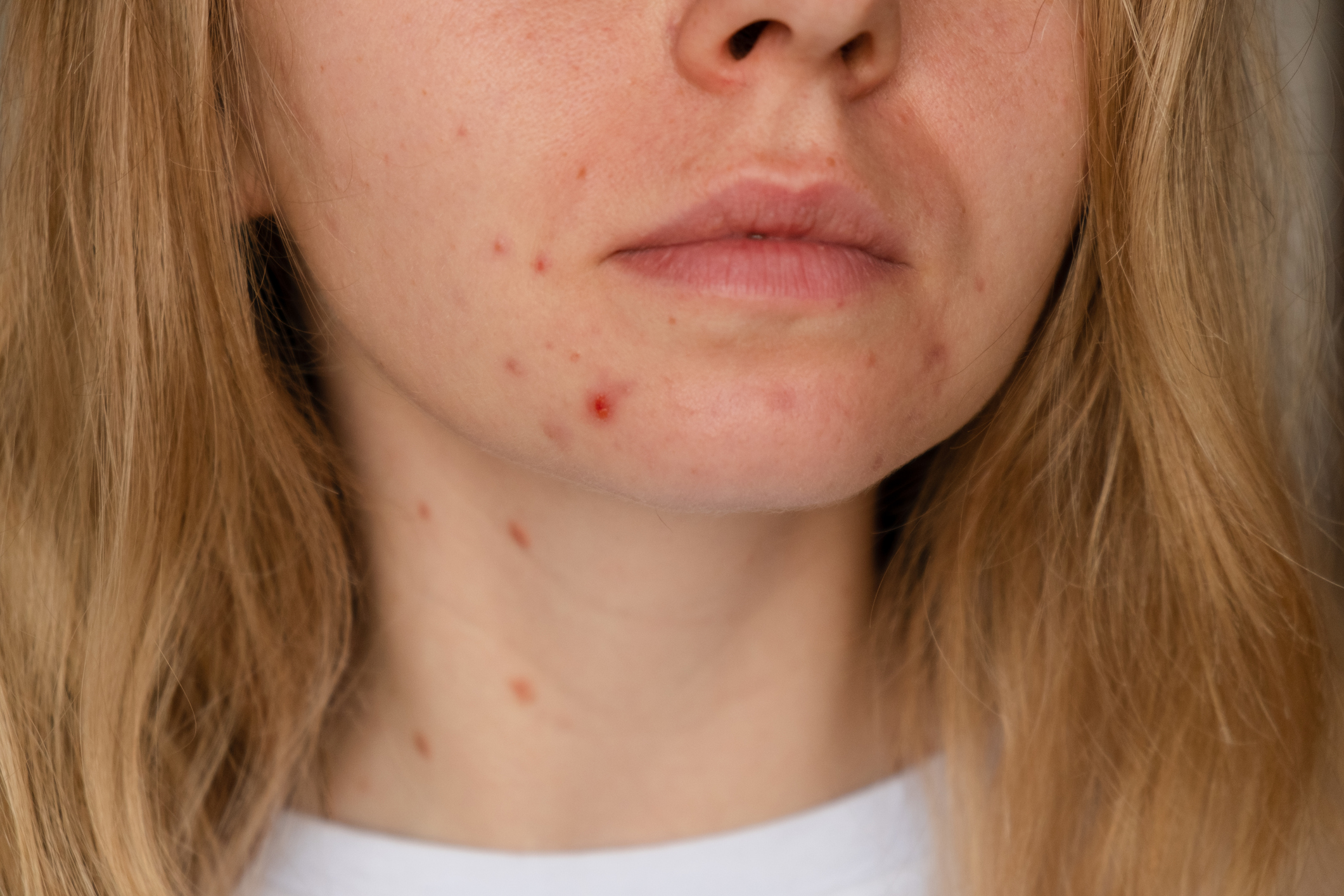 Post Acne Marks: Effective Fading Methods