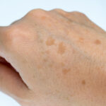 Age Spots