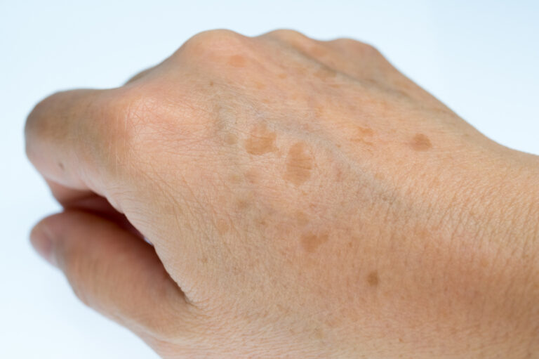 Solar Lentigines: Age Spots, Liver Spots, Sun Spots, Senile Freckles Explained Causes & Care