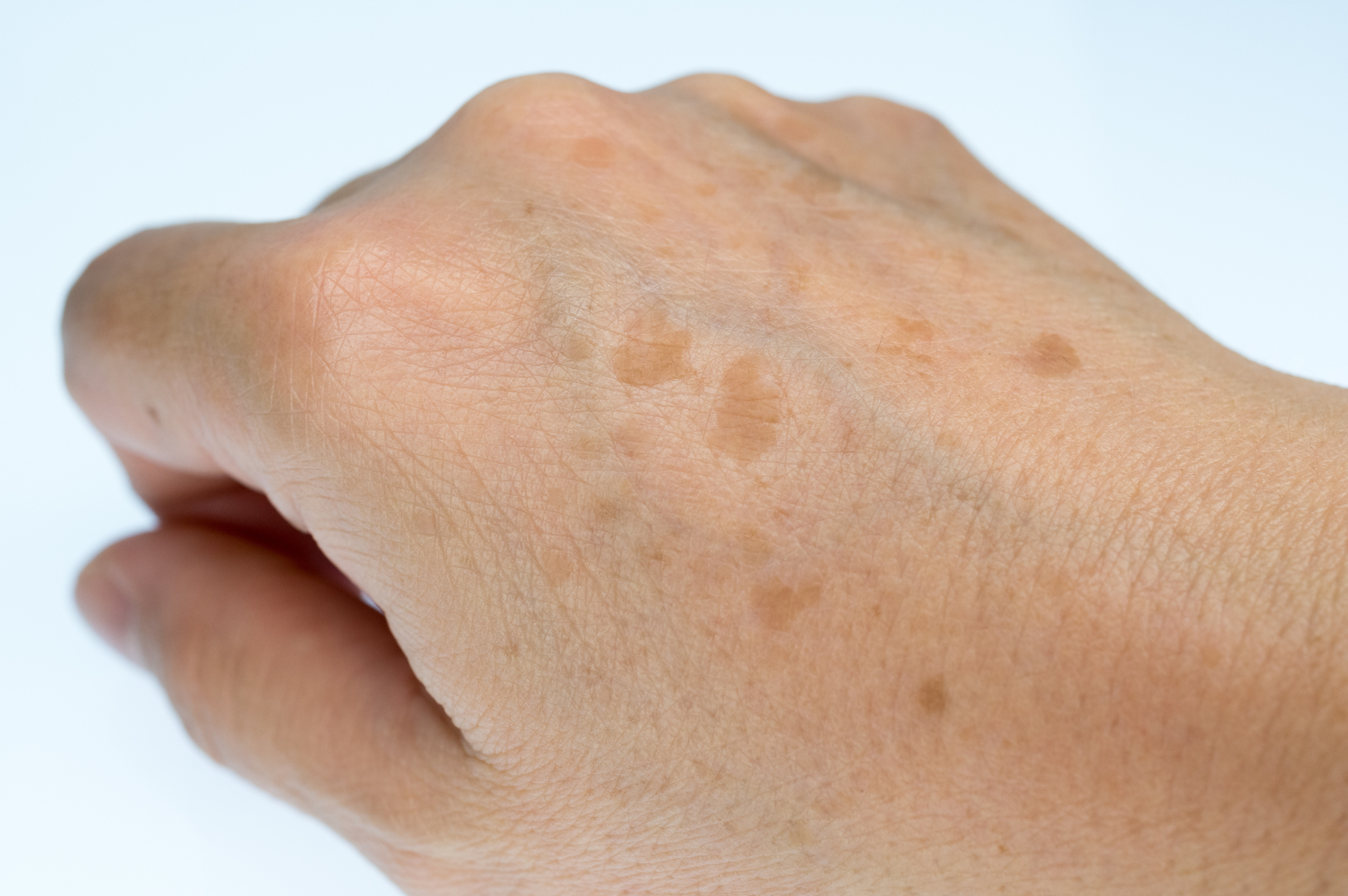 Solar Lentigines: Age Spots, Liver Spots, Sun Spots, Senile Freckles Explained Causes & Care