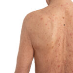 Actinic Keratosis