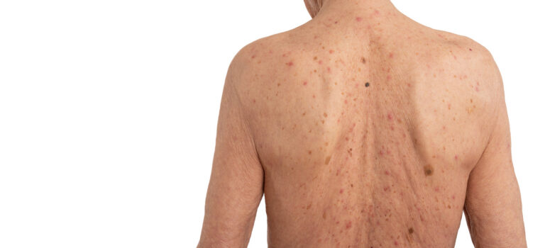 Actinic Keratosis: Symptoms, Causes, Treatment