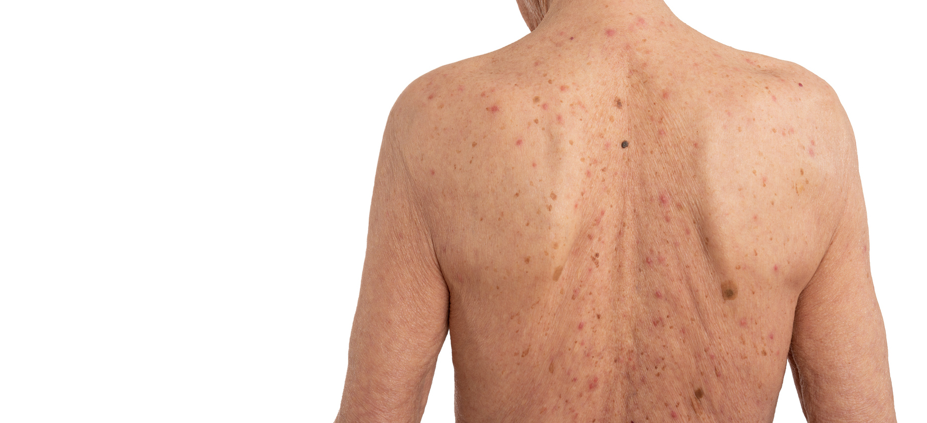 Actinic Keratosis: Symptoms, Causes, Treatment Actinic Keratosis: Symptoms, Causes, Treatment