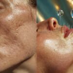 Spicule Microneedling