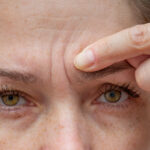 Eyebrow Loss
