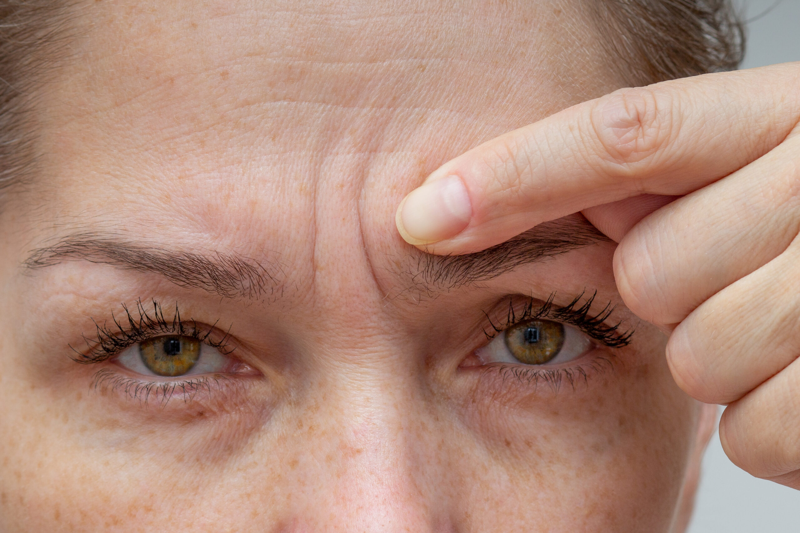 Eyebrow Loss Causes & Solutions