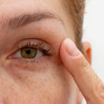 Eyelash Loss