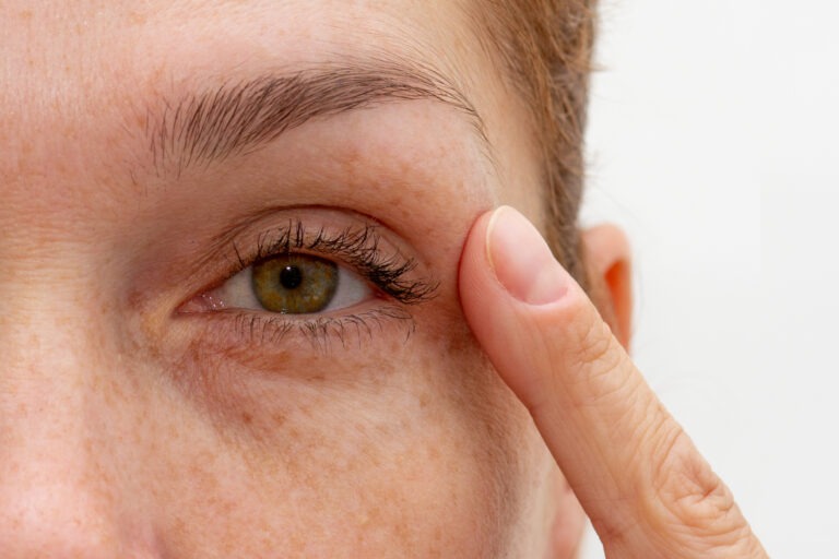 Eyelash Loss Causes & Solutions