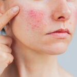 Skin Redness