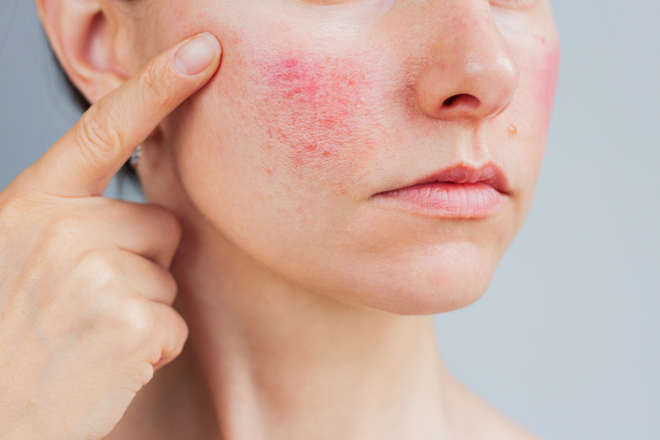 Skin Redness