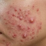 Inflammatory Acne