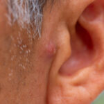 Nodular Acne