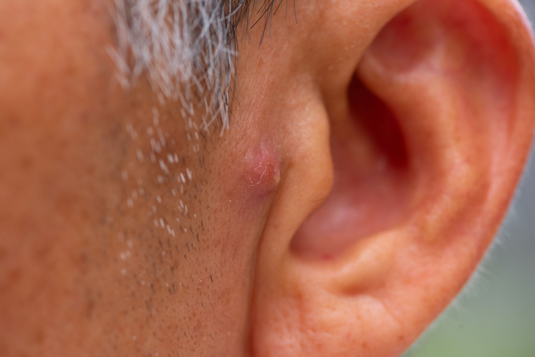 Nodular Acne Treatment Guide Nodular Acne Treatment Guide